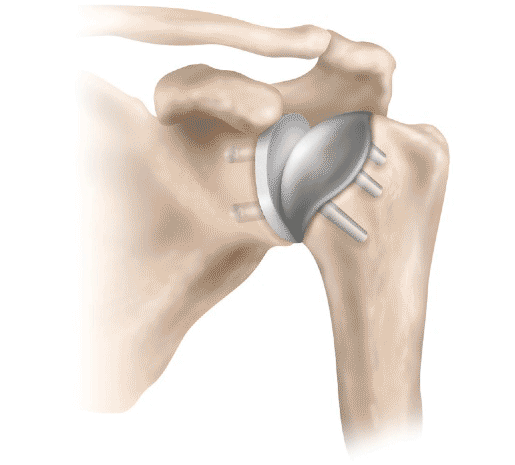 Total Shoulder Replacement Surgery